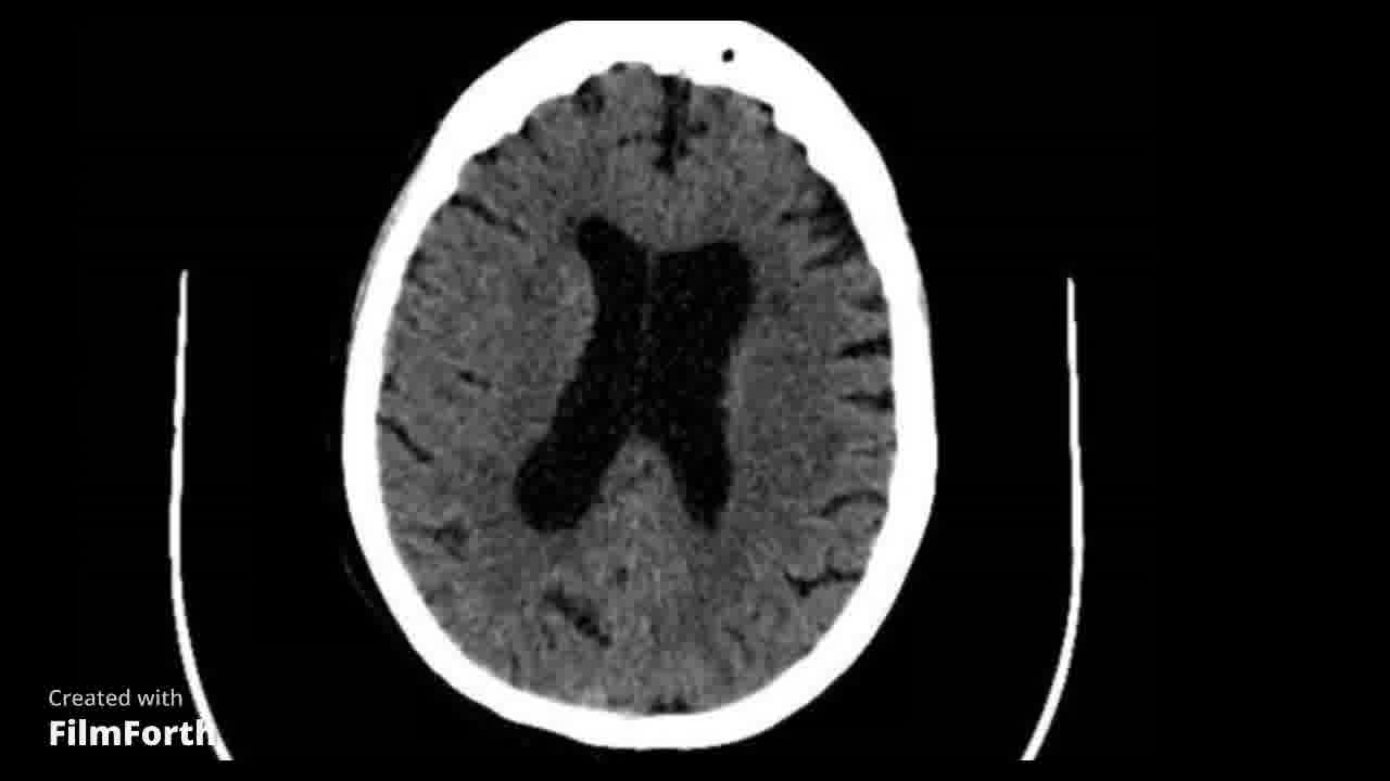 Asimetría ventricular