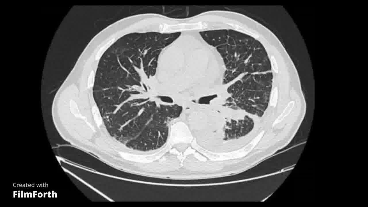 Masa pulmonar