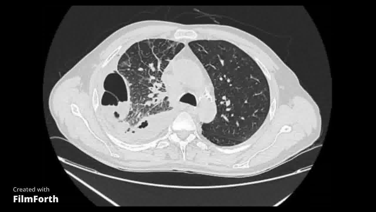 Fístula broncopulmonar