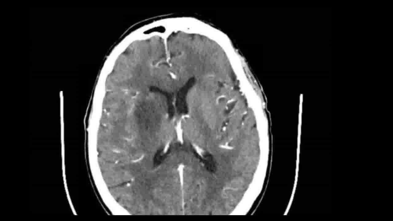 Ictus isquémico versus infección