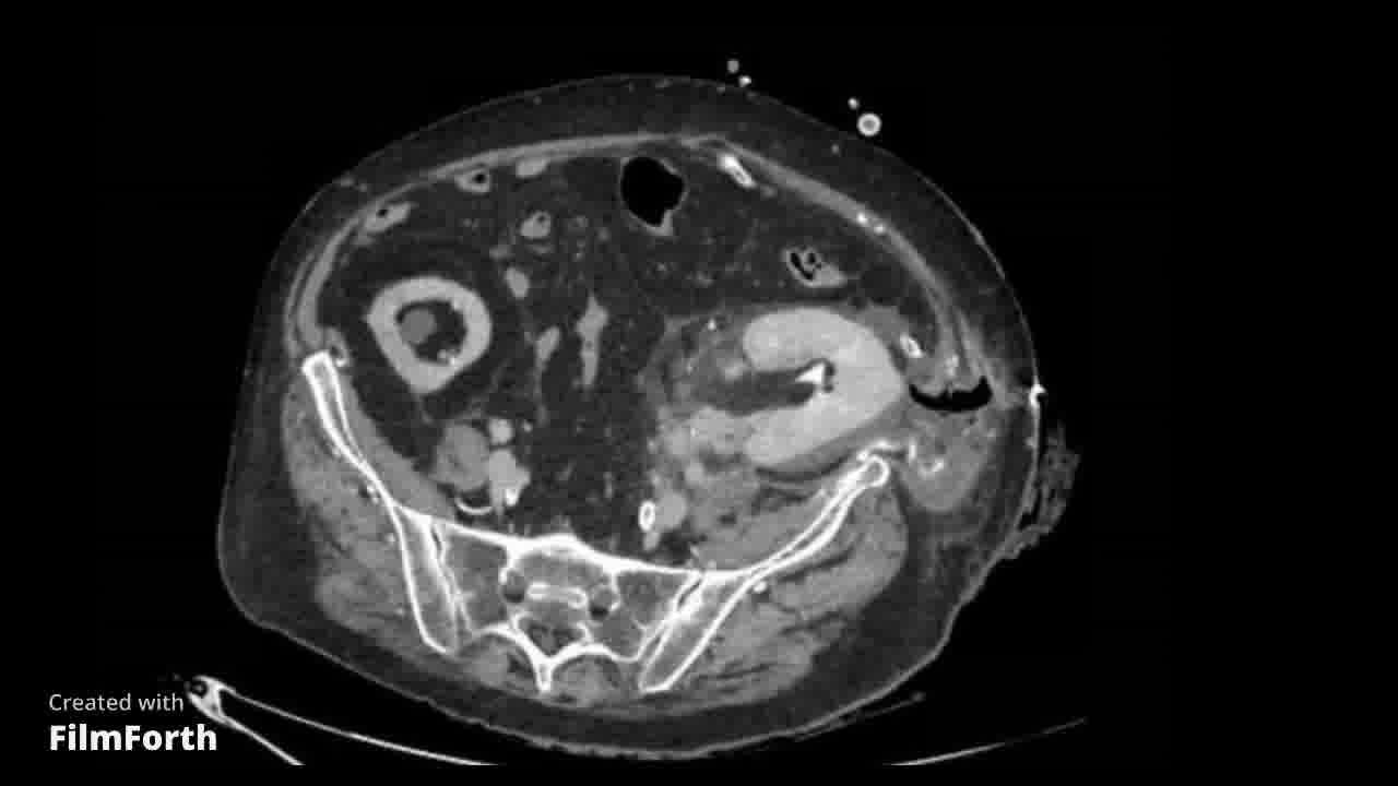 Fuga urinaria por lesión ureteral