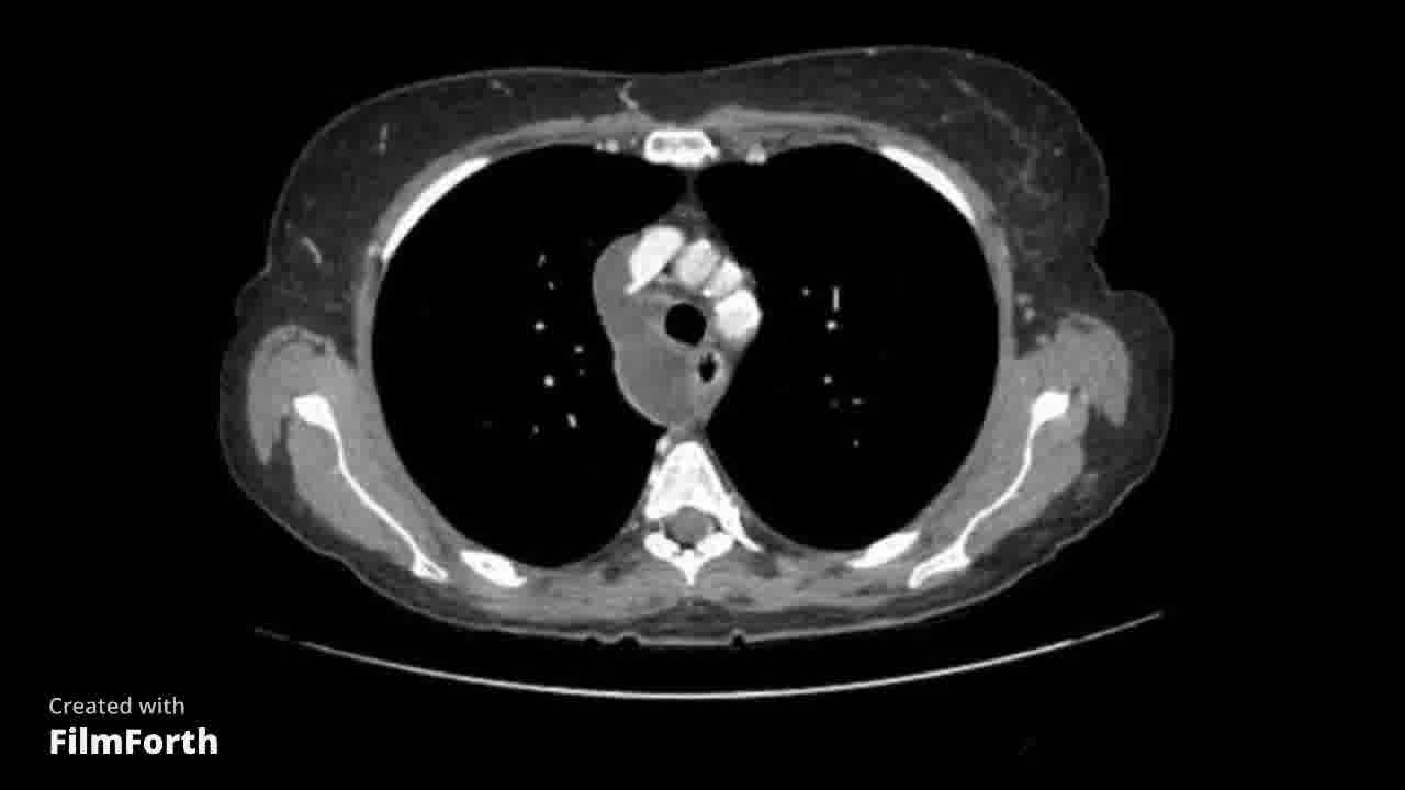 Absceso mediastínico