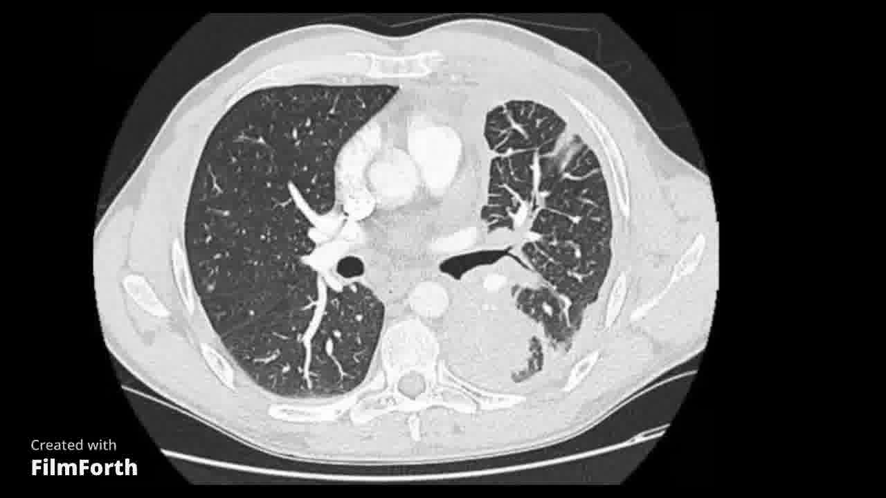 Neumonitis obstructiva