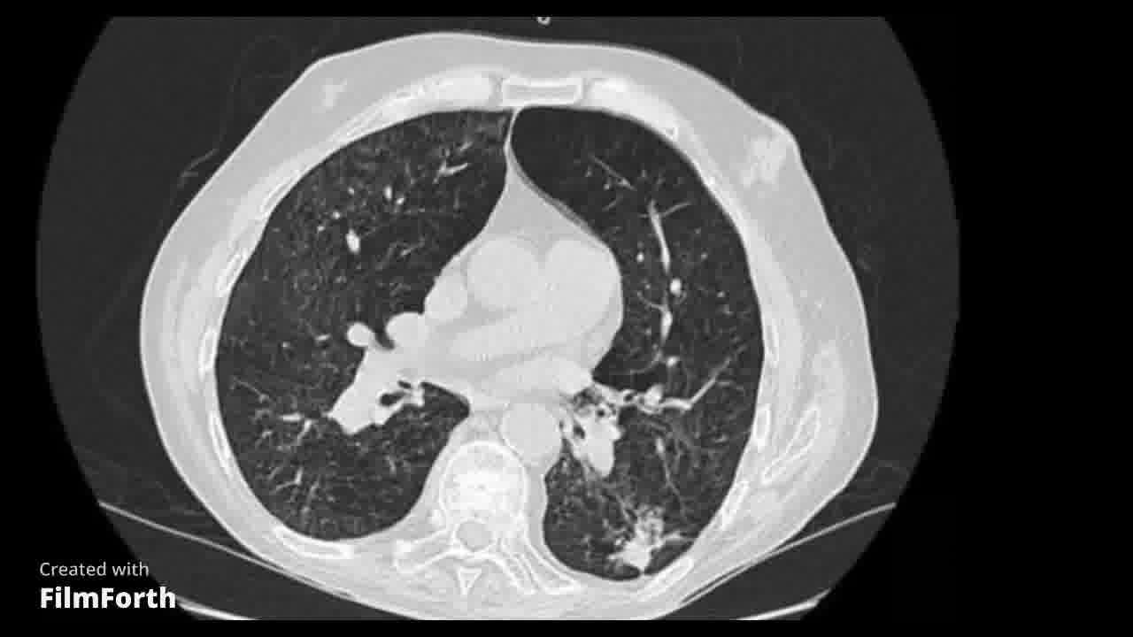 Cavitación pulmonar infecciosa