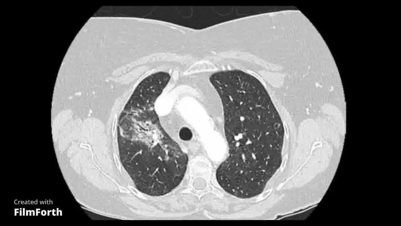 Neumonitis postradioterapia