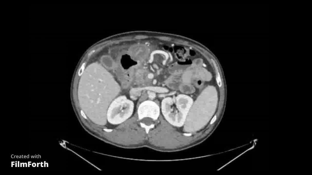 Pancreatitis crónica reagudizada