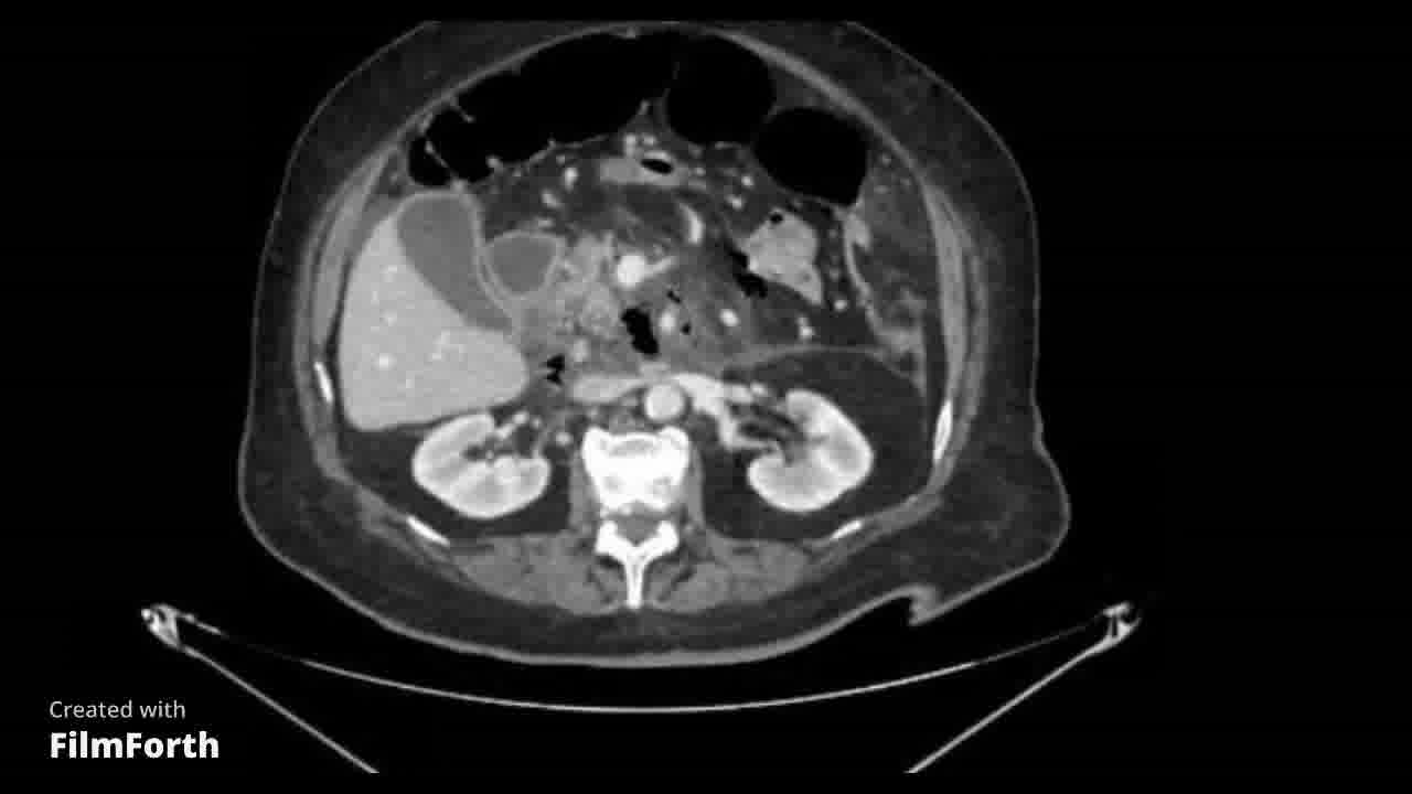 Complicación post CPRE