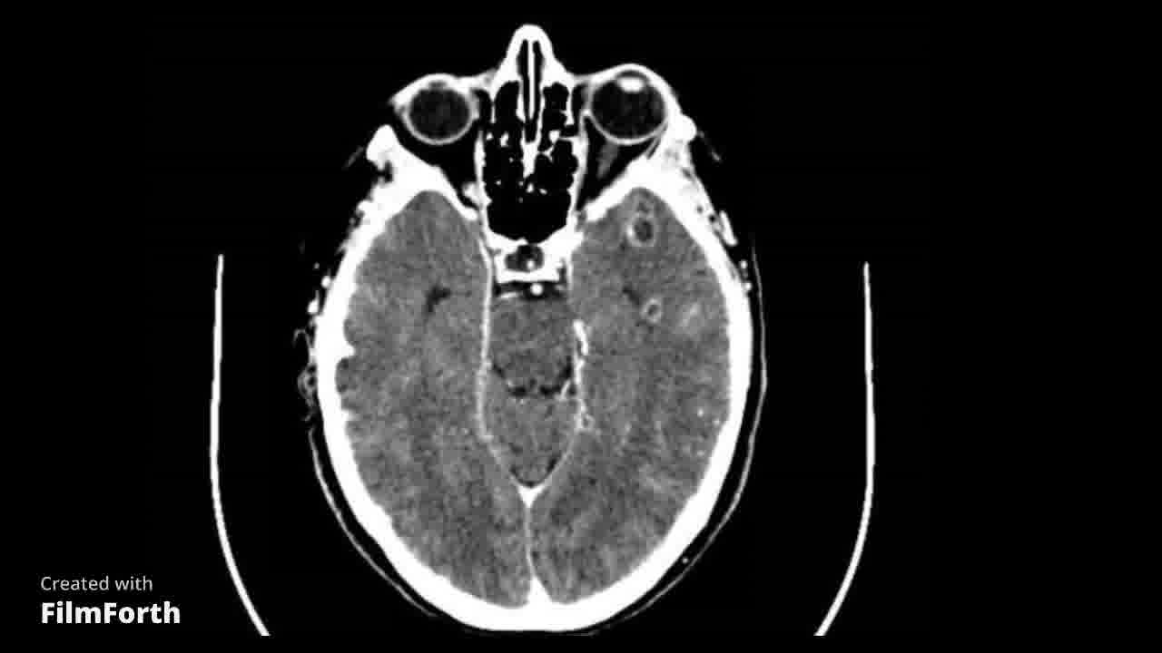 Absceso cerebral vs metástasis