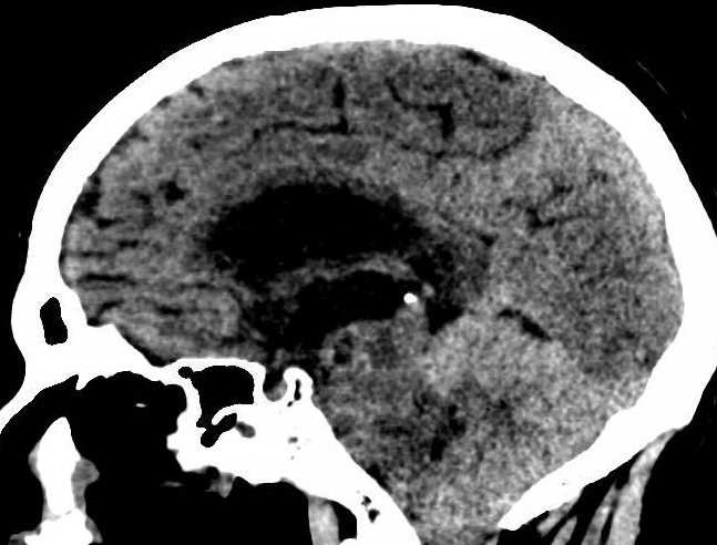 Cerebelitis DIFUSA