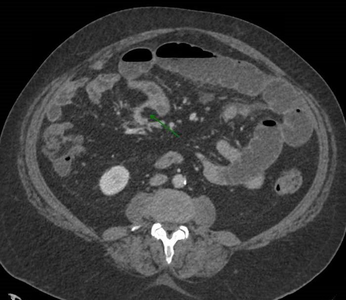 Tumor carcinoide instestinal