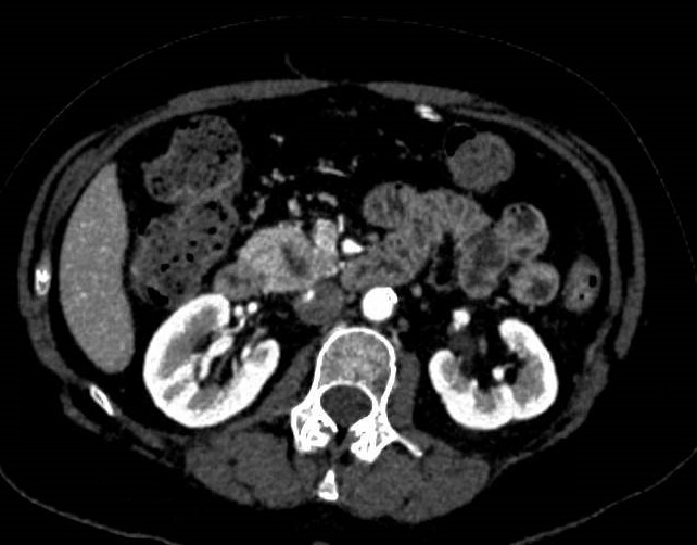 Pancreatitis focal