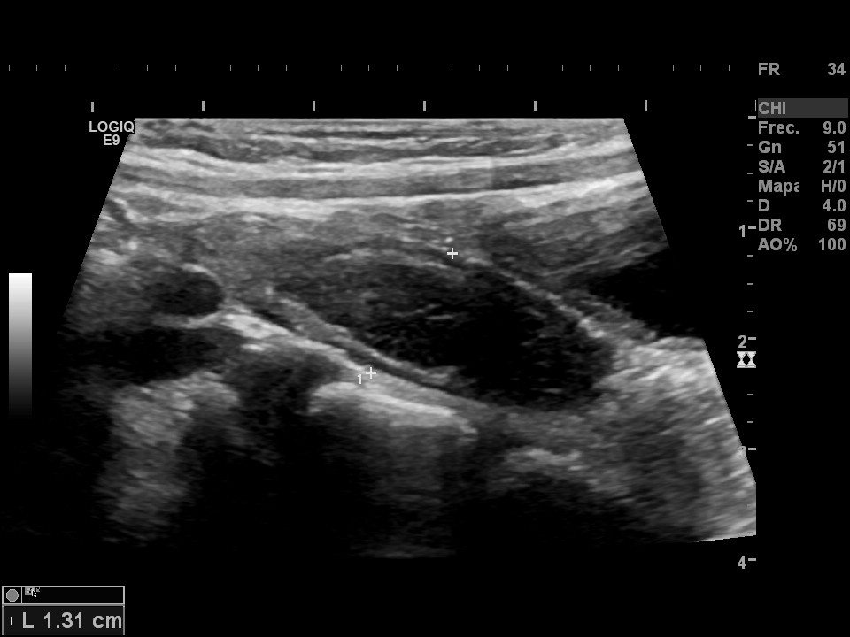 Hiperplasia apendicular