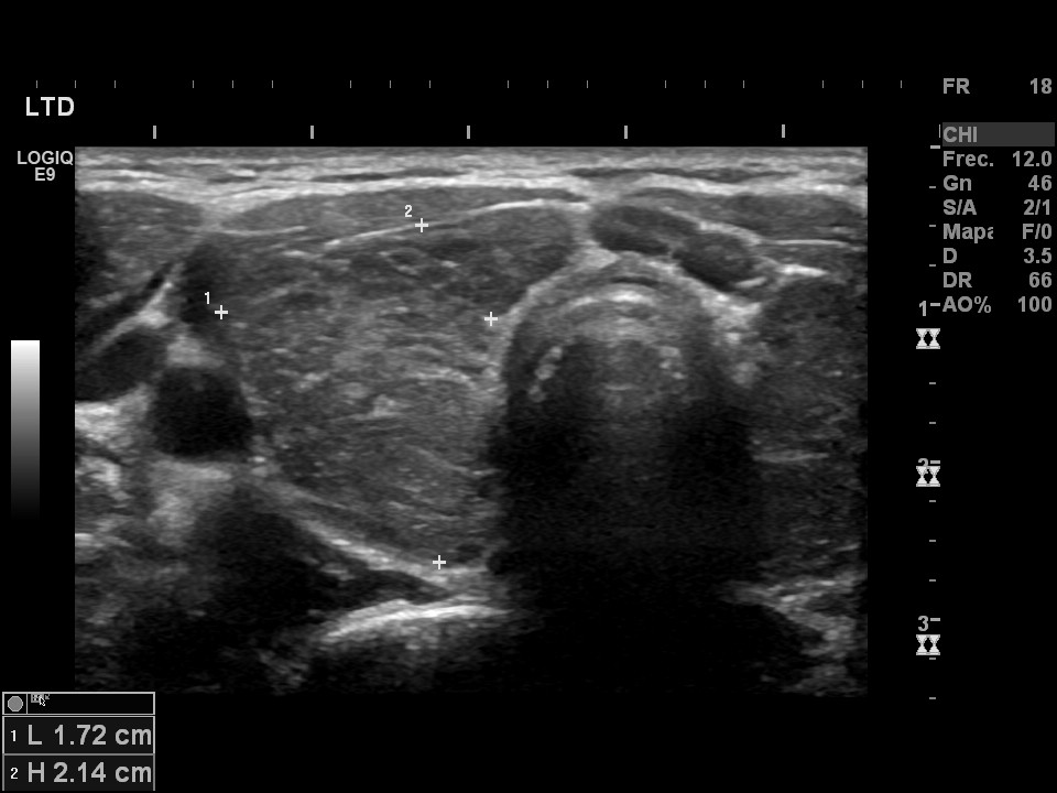 Tiroiditis