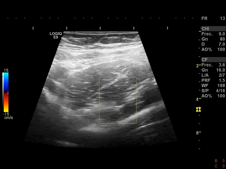 Neurofibromas crurales