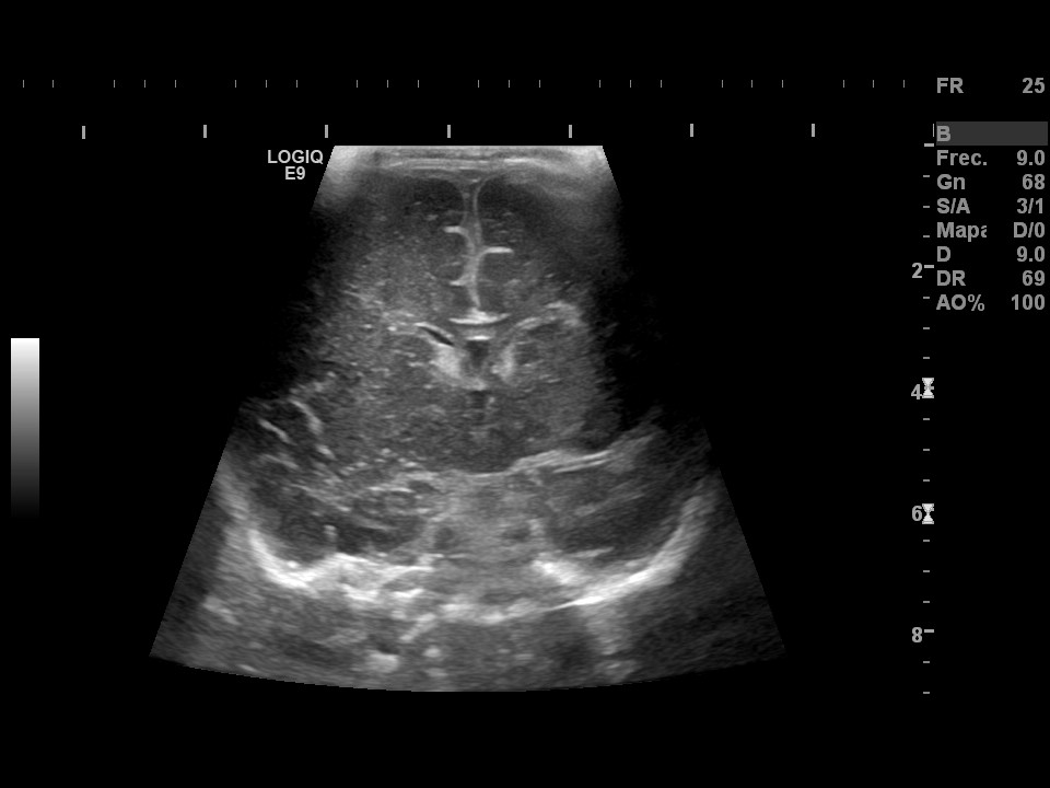 Hemorragia matriz germinal