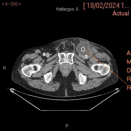 Posible hematoma evolucionado