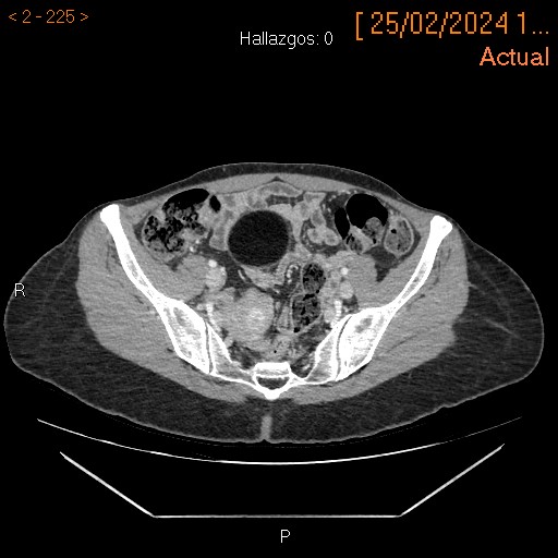 Teratoma ovárico con torsión anexial