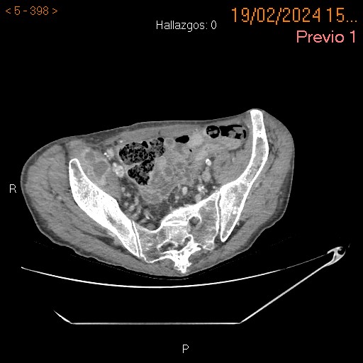 Espondilodiscitis con afectación aórtica