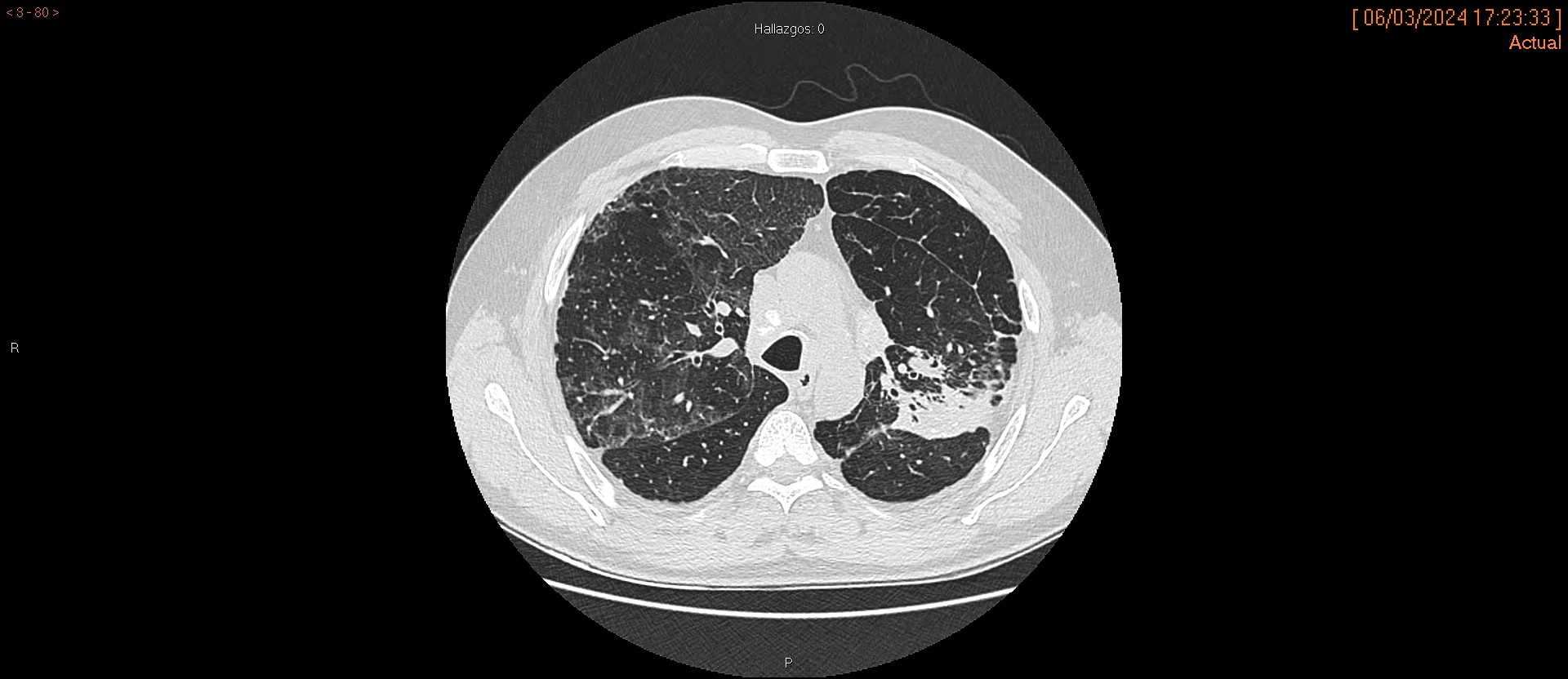 Neumoconiosis