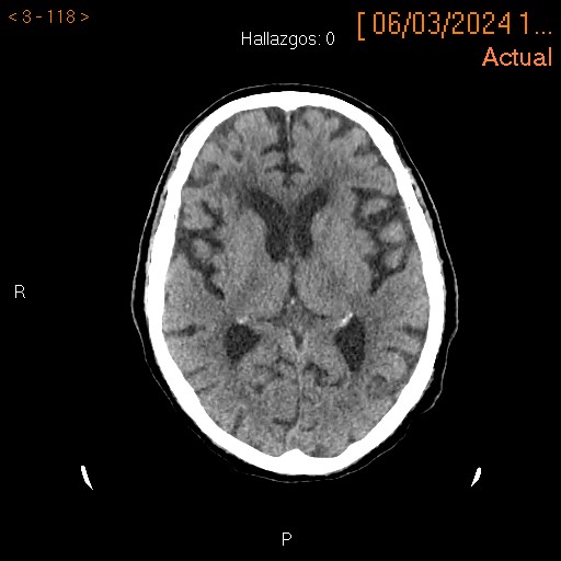 Gliosis en TC