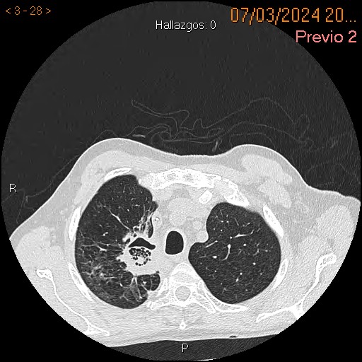 Aspergilosis pulmonar invasiva