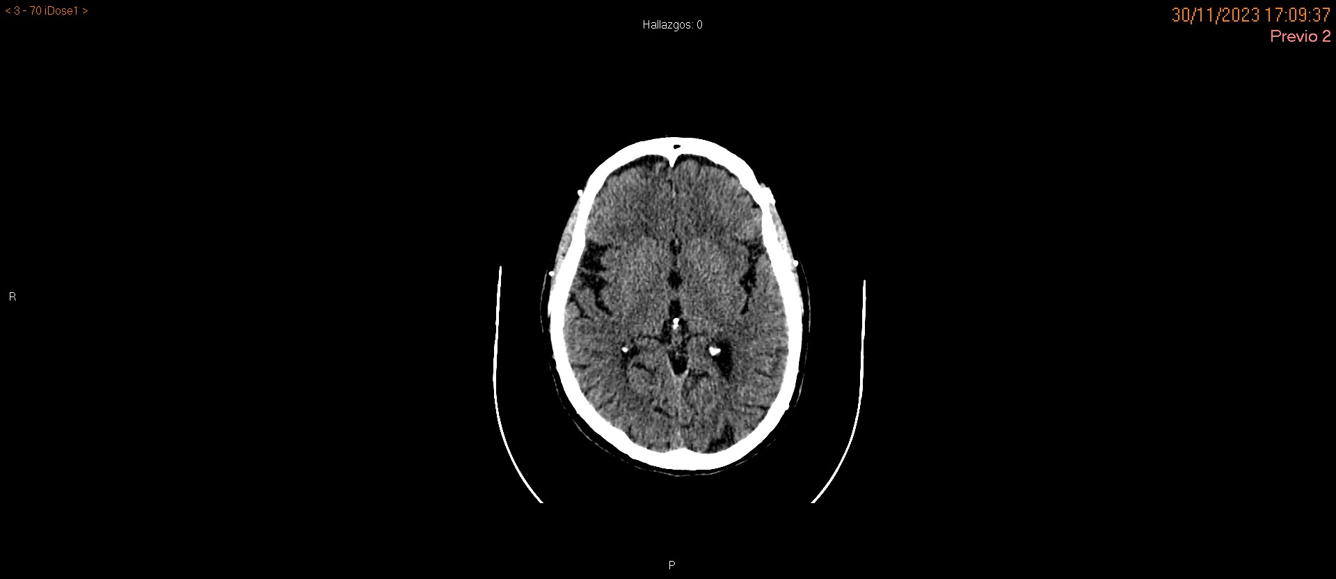 Lesión corticosubcortical; difícil visualización